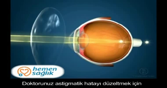 Astigmatizmde Gözlük Kullanmak